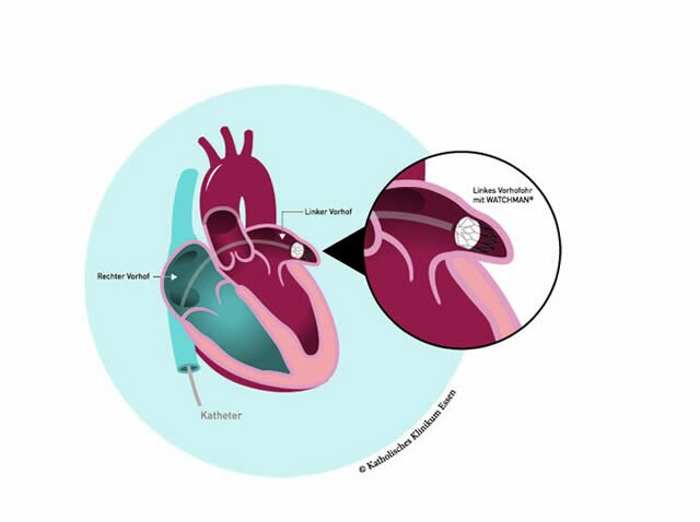 Implantat - geformt wie ein kleiner Fallschirm -, mit dem der Arzt das linke Vorhofohr verschließt